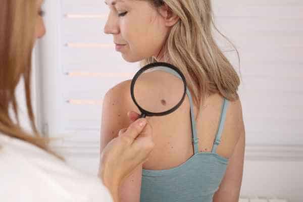 What Are Traditional Skin Lesion Removal Methods Durham?