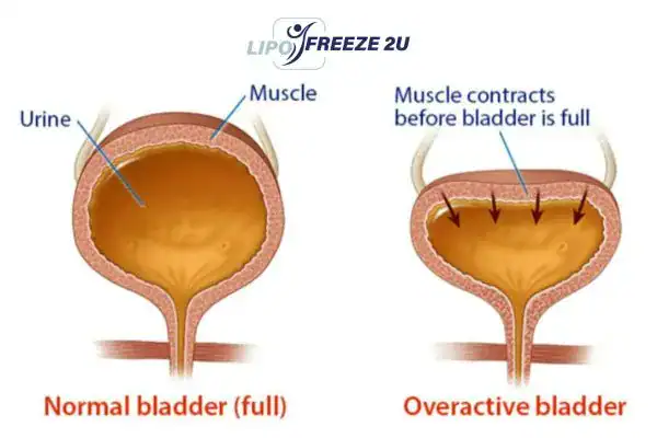 diagram of overactive bladder treatment Durham