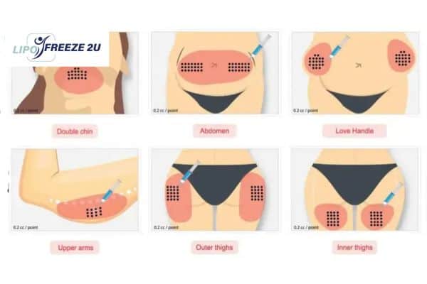 Benefits of Choosing Aqualyx for Fat Reduction Durham