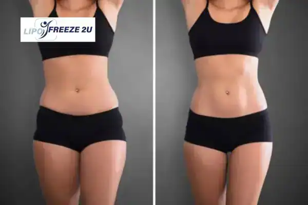 How Can LIPO FREEZE 2U Support Your Post-Pregnancy Body Recovery Durham?