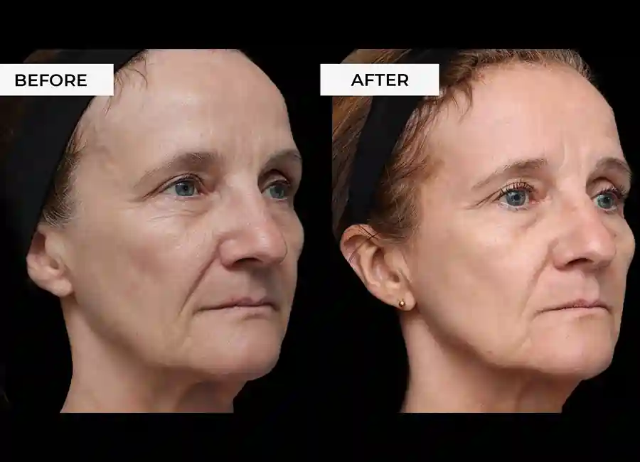 How Many RF Microneedling Sessions Will You Need to See a Difference Durham?