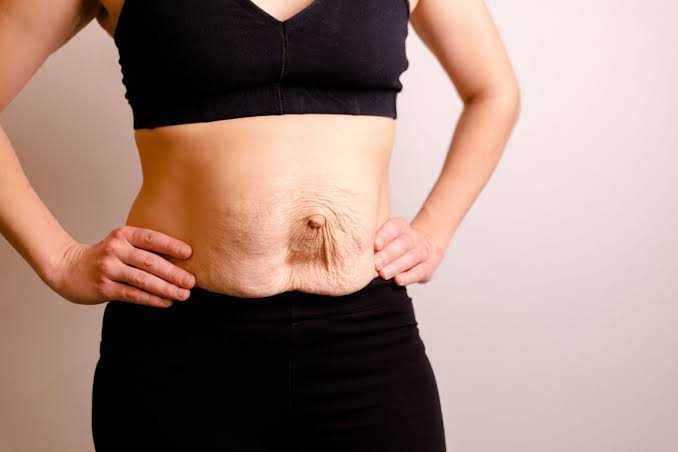 Is Surgery Really the Only Way to Repair Diastasis Recti Durham?