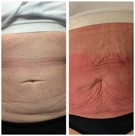 How Does RF Microneedling Improve Crepey, Thin and Uneven Skin Texture Durham?