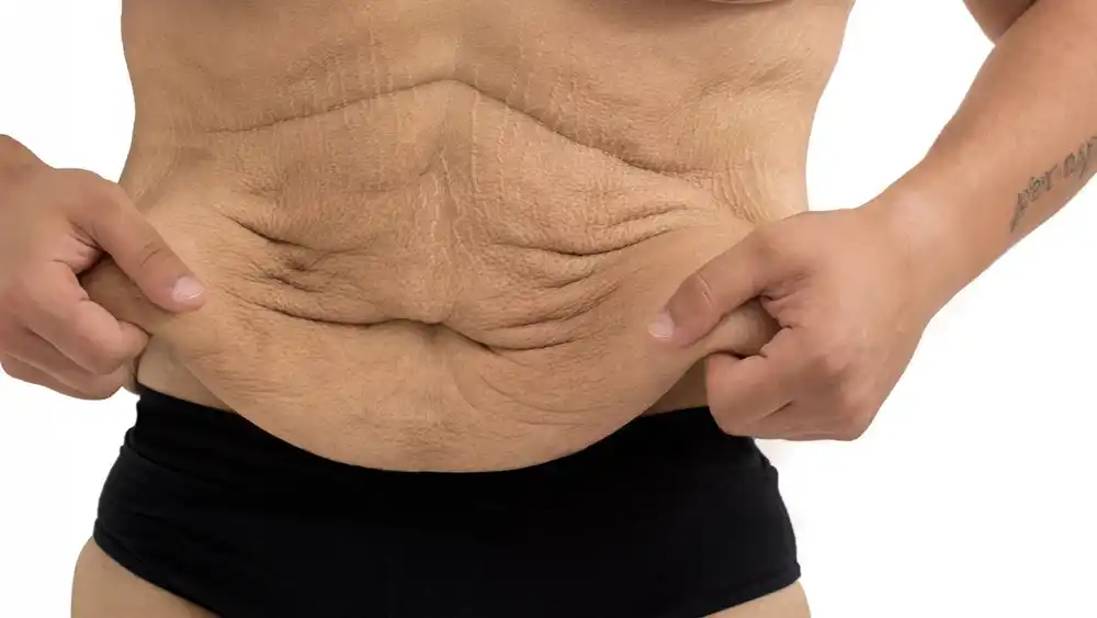 Why Does Weight Loss Medication Leave Some People With Loose or Sagging Skin Durham?